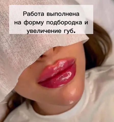 увеличение губ, фото 5